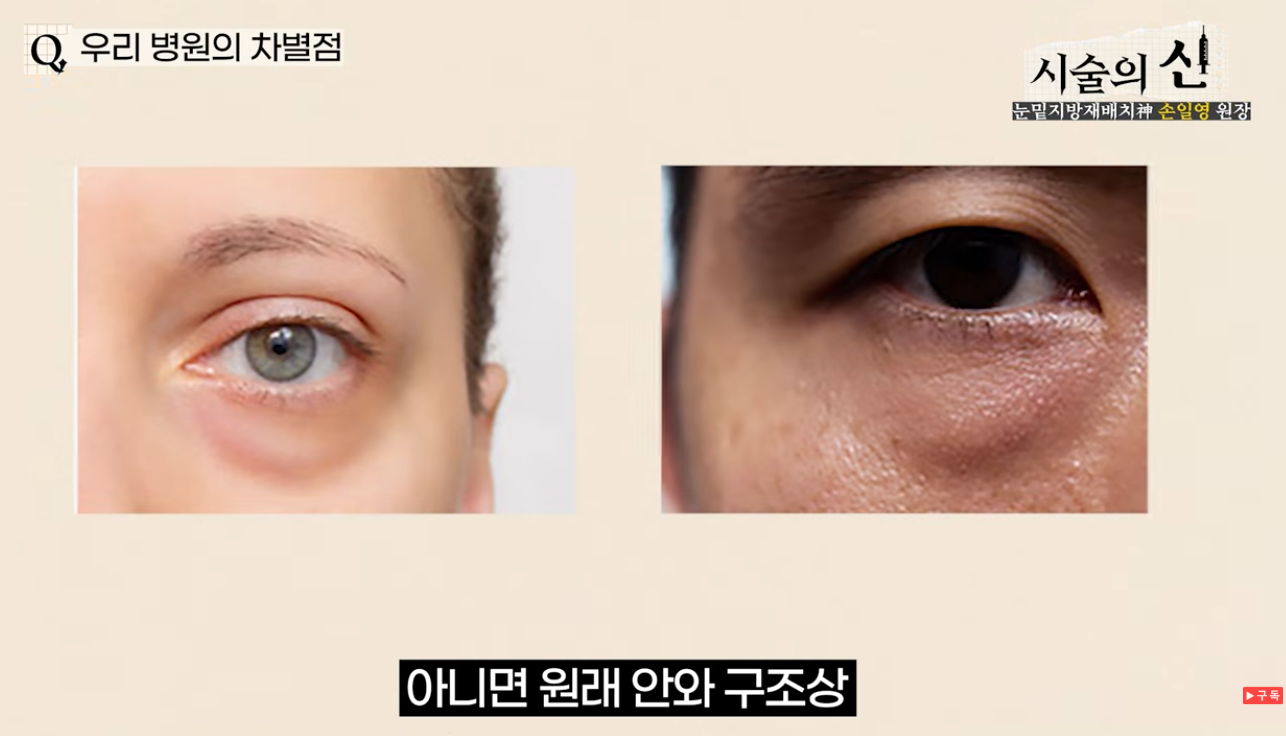 눈밑지방재배치 잘하는곳, 지방 위치까지 확인해야 하는 이유 | 손일영의 눈밑 노트 4편