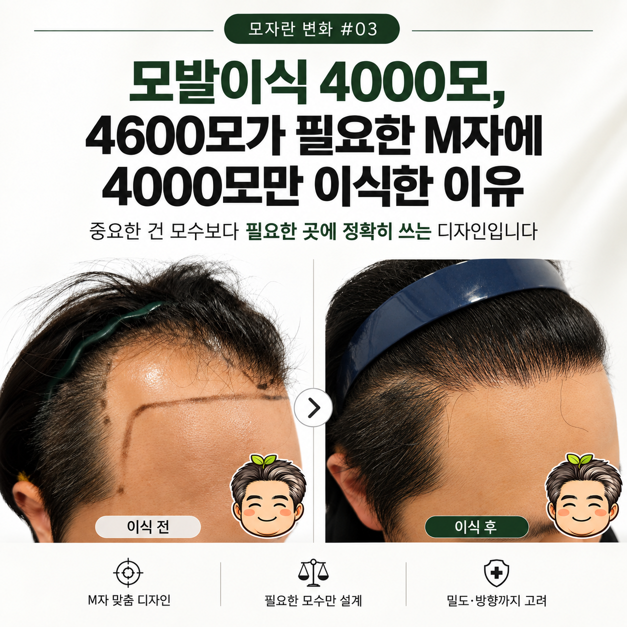 모발이식 4000모, 4600모가 필요한 M자에 4000모만 이식한 이유 [모자란 변화 #03]