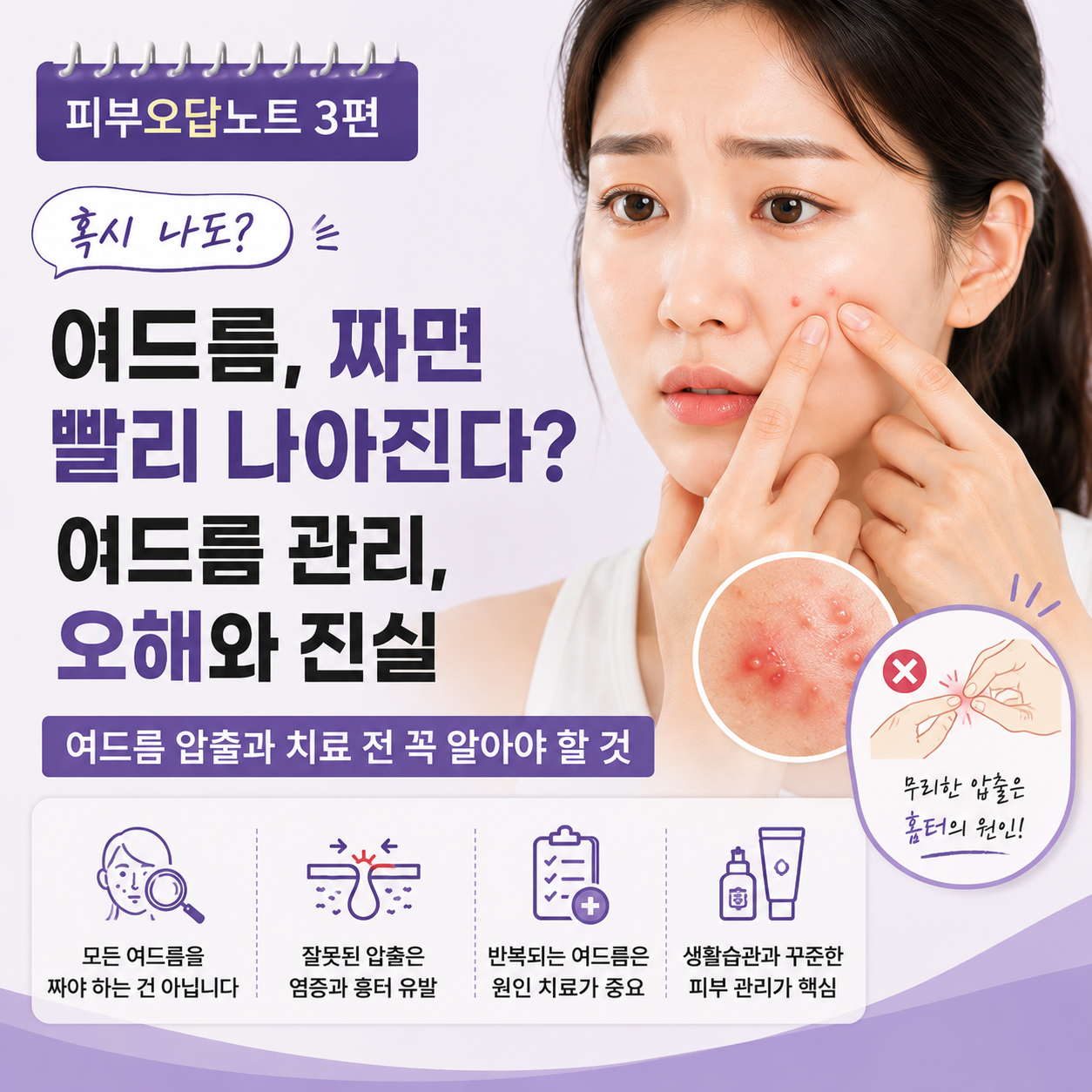 여드름 관리, 잘못된 압출이 자국·흉터로 이어지는 이유 [피부오답노트 3편]