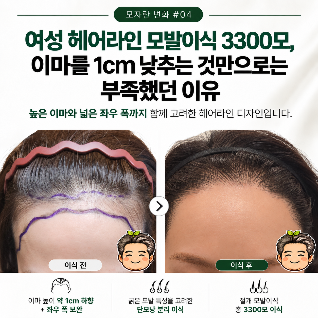 여성 헤어라인 모발이식 3300모, 이마를 1cm 낮추는 것만으로는 부족했던 이유 [모자란 변화 #04]