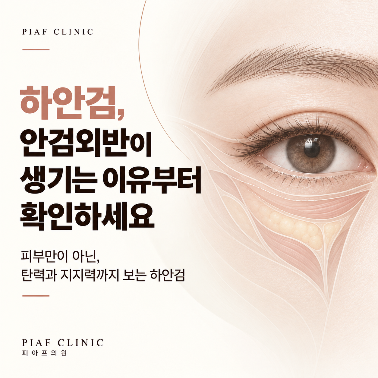 송파 피부과 하안검, 안검외반 원인과 수술 전 체크할 점