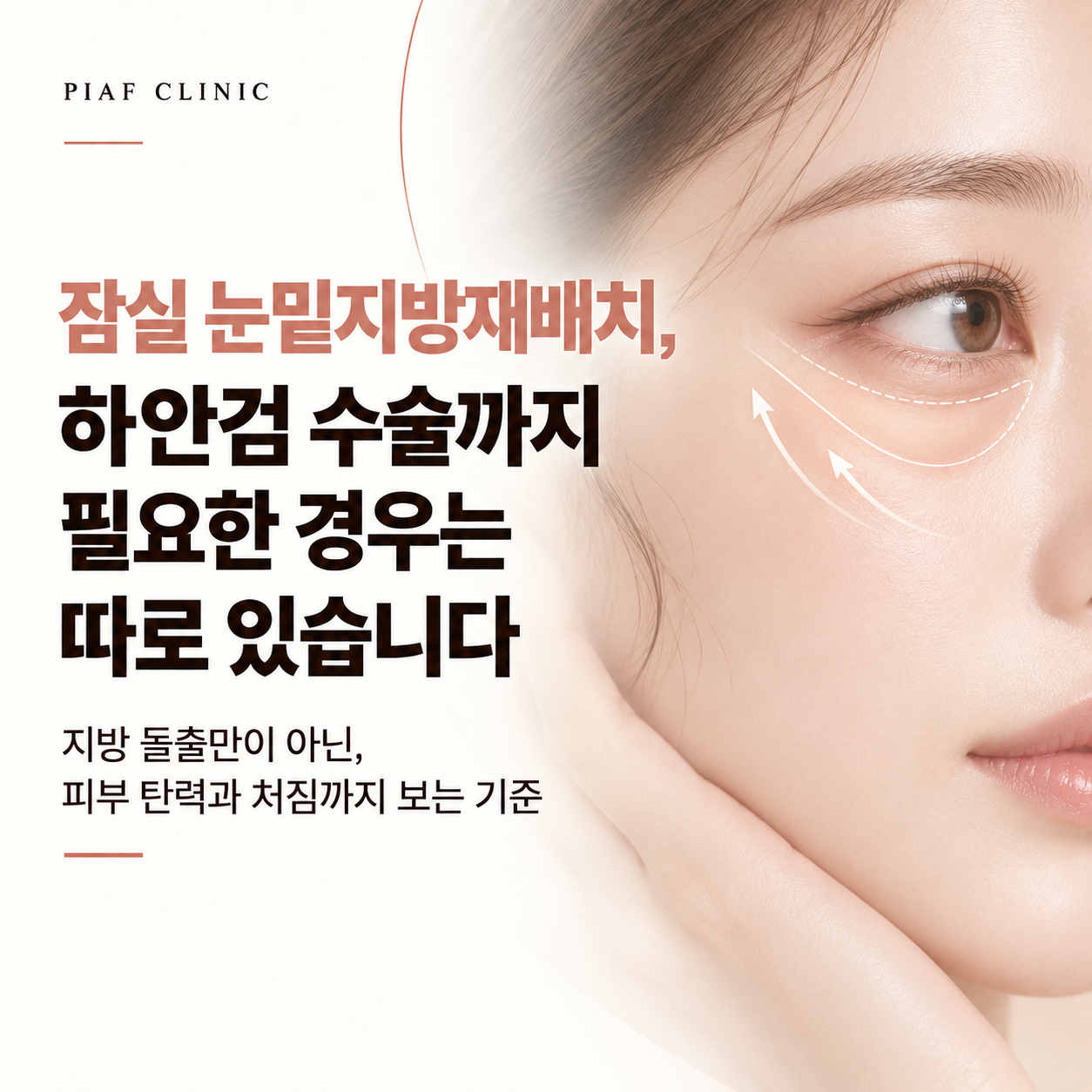 잠실 눈밑지방재배치 vs 하안검, 어떤 경우에 하안검 수술까지 필요할까요?