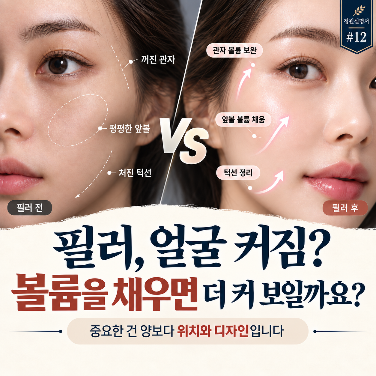 필러 얼굴 커짐, 많이 채워서가 아니라 위치가 중요합니다｜정원설명서 #12