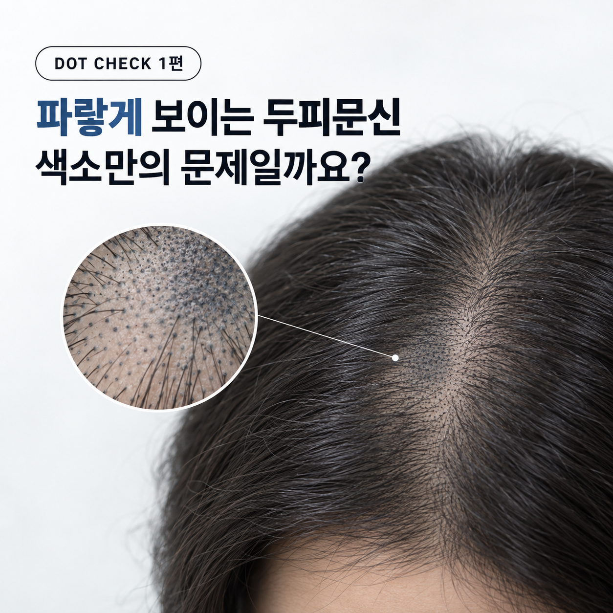 SMP 두피문신 파랗게 변하는 이유, 색소만의 문제일까요? | DOT CHECK 1편