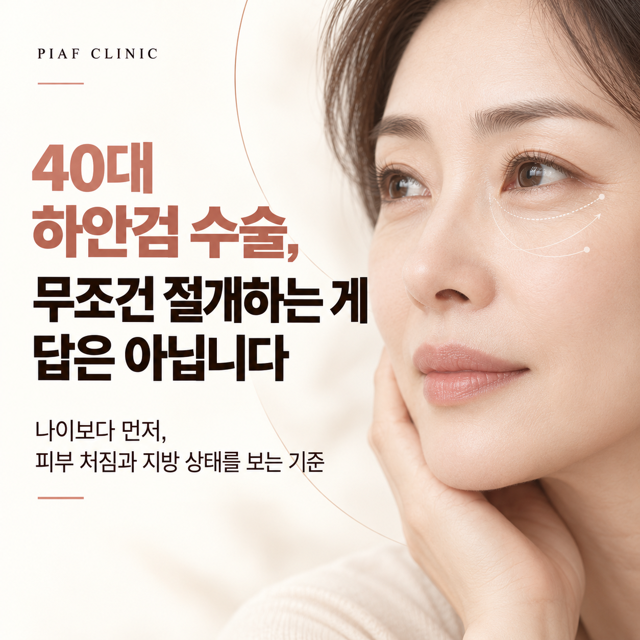 40대 하안검 수술, 절개와 결막 접근 차이와 선택 기준