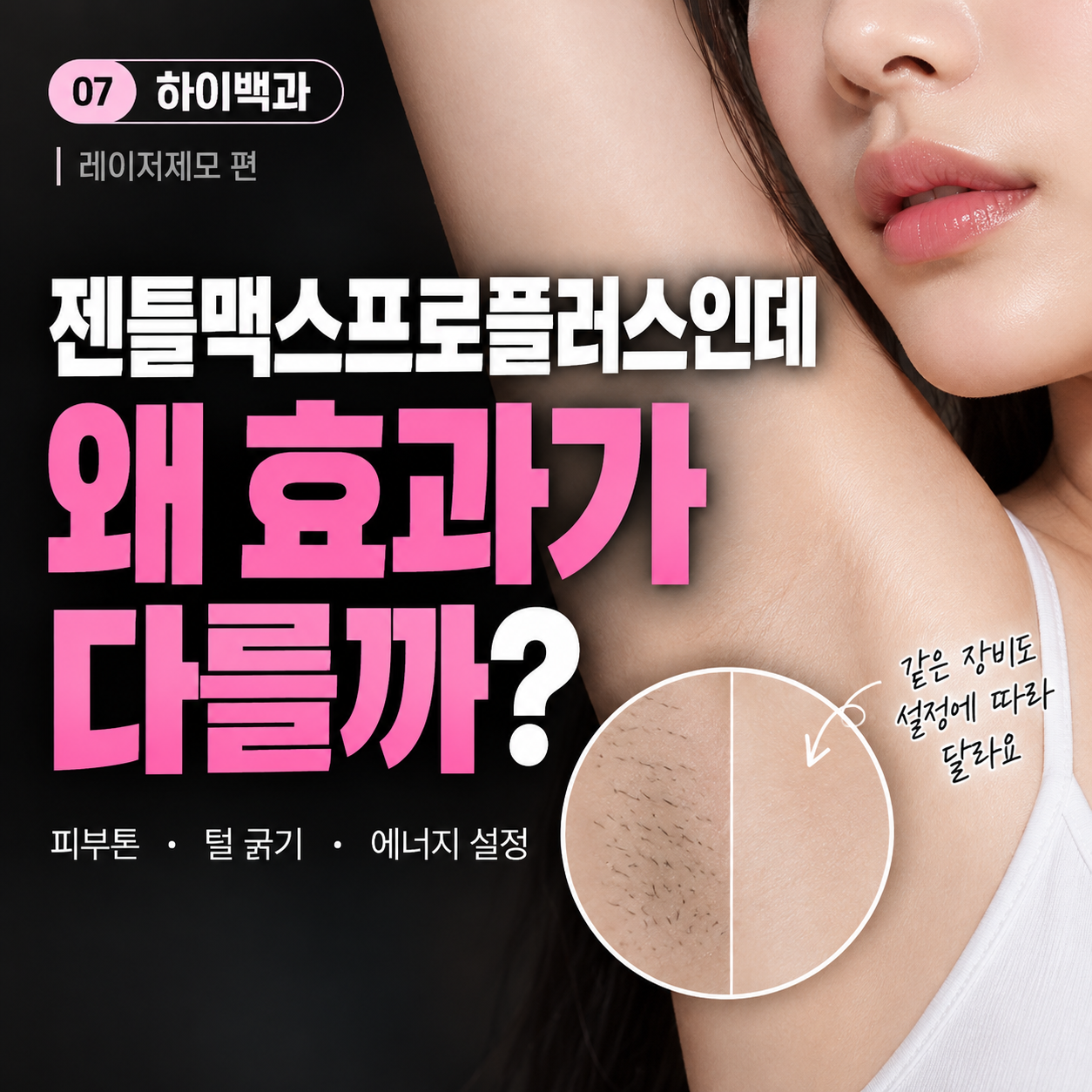 대구 젠틀맥스프로플러스, 레이저제모 효과는 장비보다 설정이 중요합니다 [하이백과 7편]