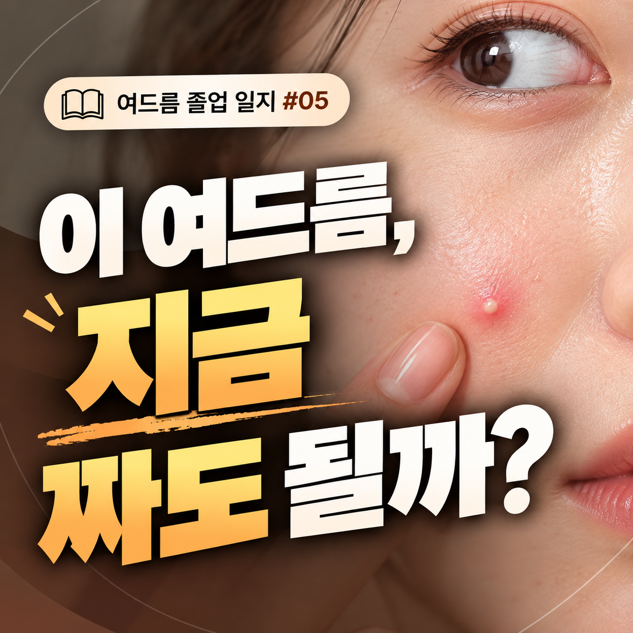 여드름 압출, 무조건 짜야 할까요? 압출이 필요한 여드름과 피해야 할 경우 <여드름 졸업 일지 5편>