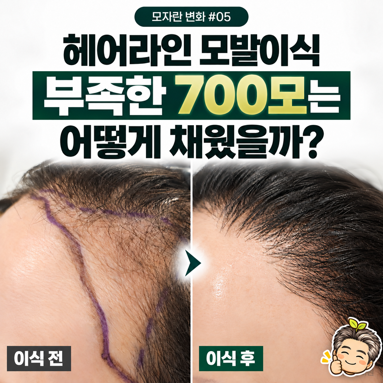 여성 헤어라인 모발이식 2700모, 절개 범위를 더 늘리지 않은 이유 [모자란 변화 #05]