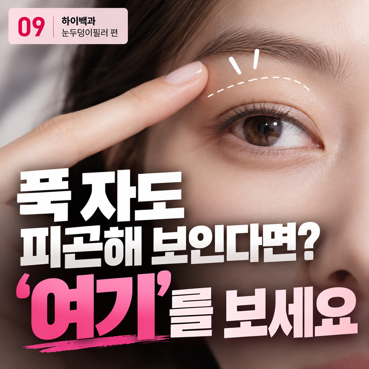 눈두덩이필러, 눈 위 꺼짐이 피곤한 눈매를 만드는 이유 [하이백과 9편]